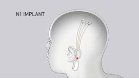 N1 implant